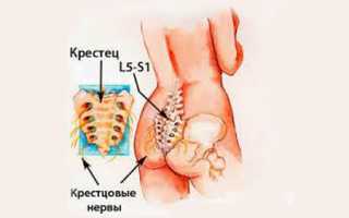 Болит спина в области крестца что это может быть