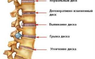 Болят и пекут все мышцы спины