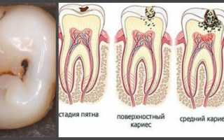 В зубе дырка болит голова