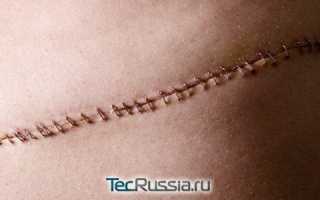 Болит послеоперационный шов на голове