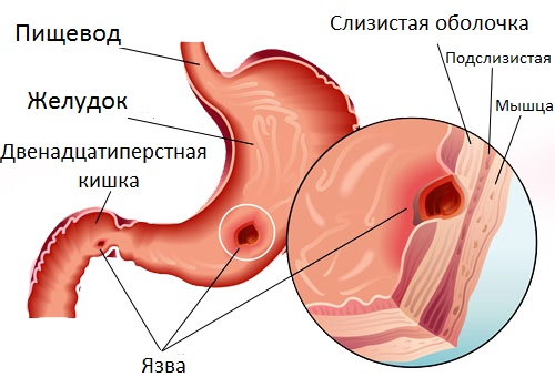Как выглядит язва желудка.