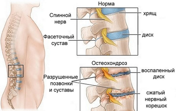 Остеохондроз