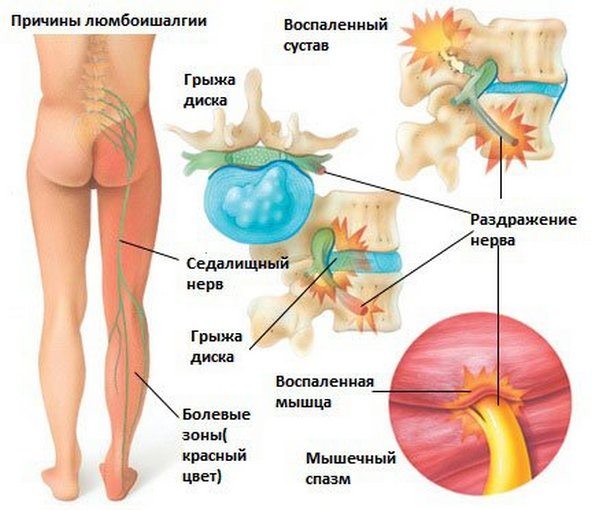 Причины люмбоишалгии