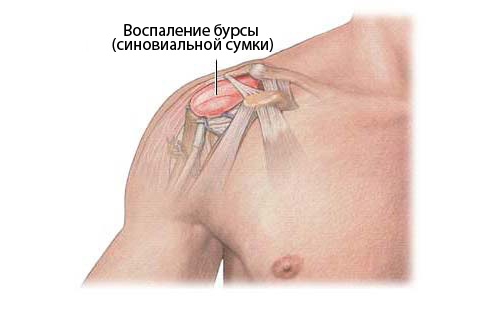 Бурсит плечевого сустава