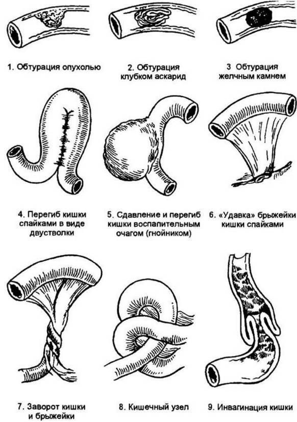 Кишечная непроходимость - возможные причины.