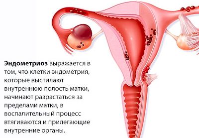 почему болит спина после месячных как при месячных