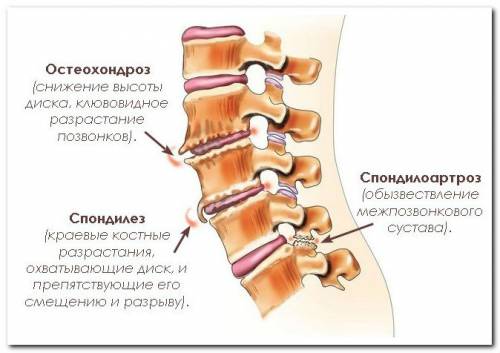 Дегенеративно-дистрофические заболевания позвоночника