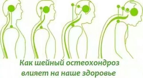 Влияние остеохондроза