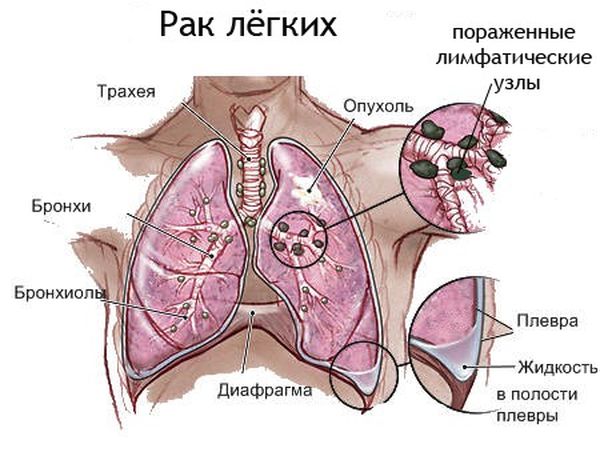 Рак легкого