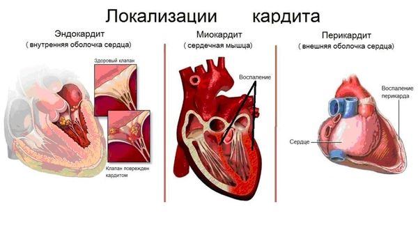 Варианты течения кардитов