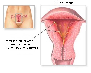 Если болит справа со спины и температура