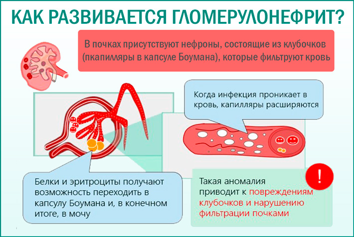 Гломерулонефрит: симптомы