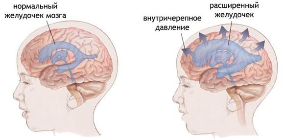 kak-uznat-vnutricherepnoe-davlenie-1