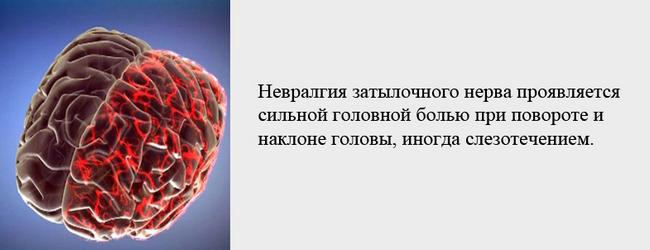 Боль при повороте головы может быть вызвана невралгией затылочного нерва