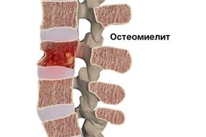 Болит спина в районе поясницы и температура
