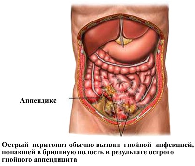 почему болит спина после месячных как при месячных