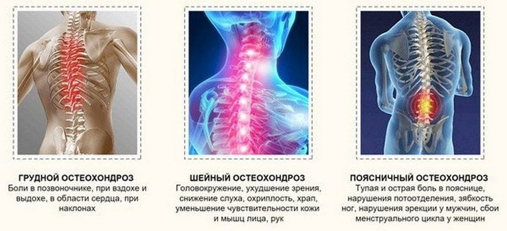 Виды остеохондроза