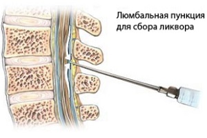 Любмальная пункция