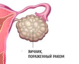 Почему яичники сильно болят и что делать