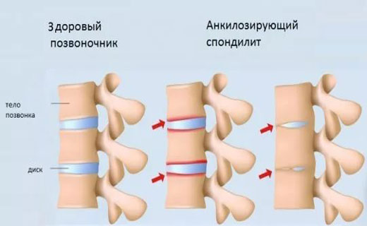 Почему болит поясница ночью лежа на спине