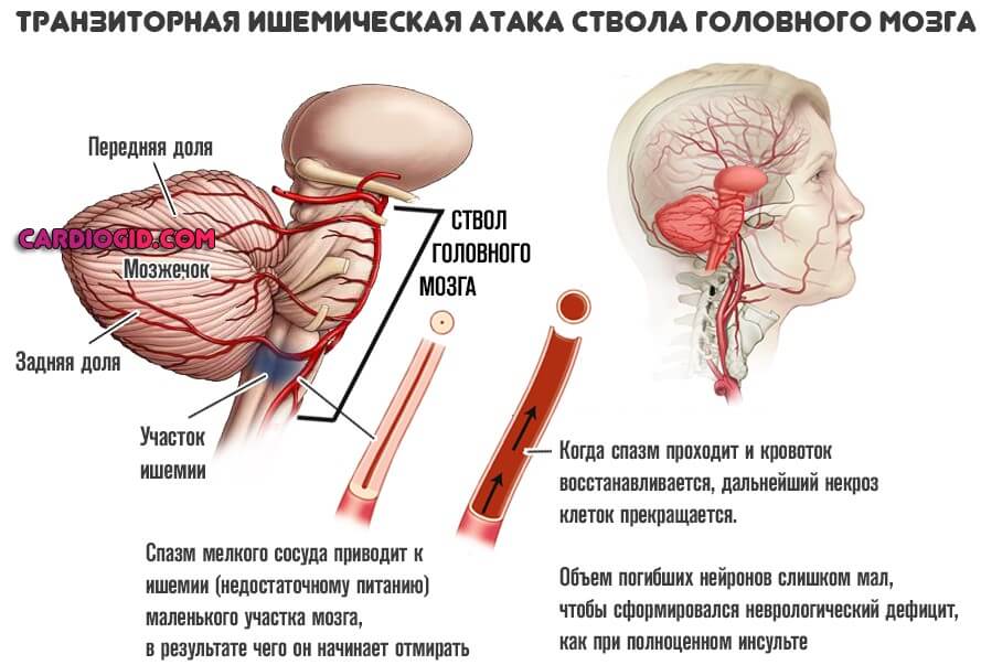 тиа ствола головного мозга